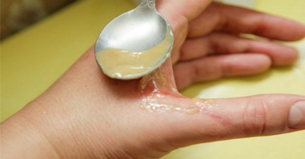 Uso de miel para quemaduras