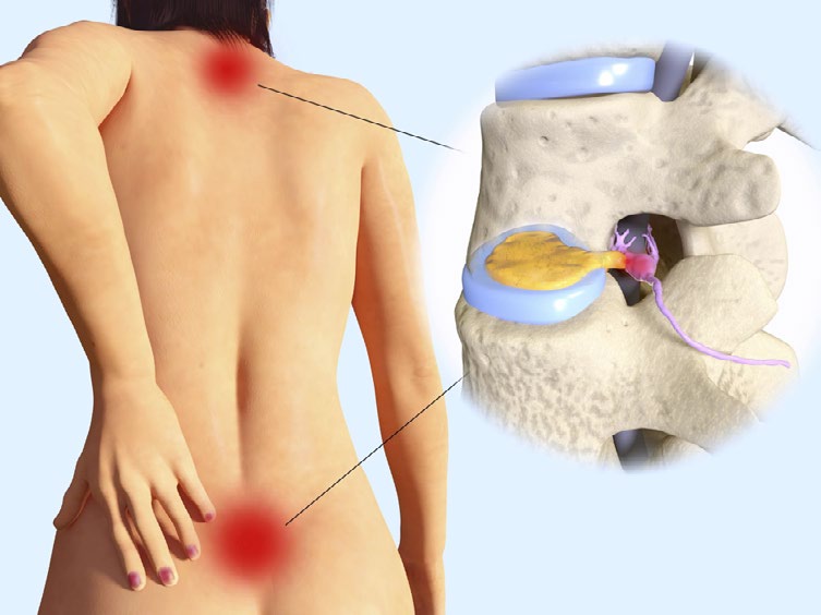 HERNIA DISCAL